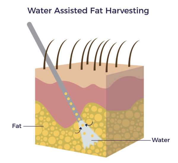 Water Assisted Fat Harvesting | AMBROSE Cell Therapy