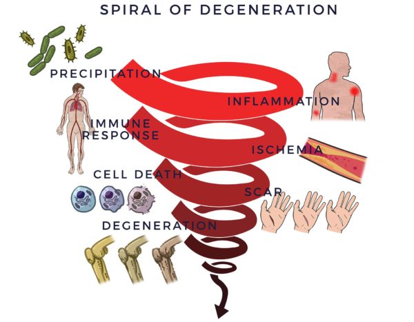AMBROSE Spiral of Joint Degeneration