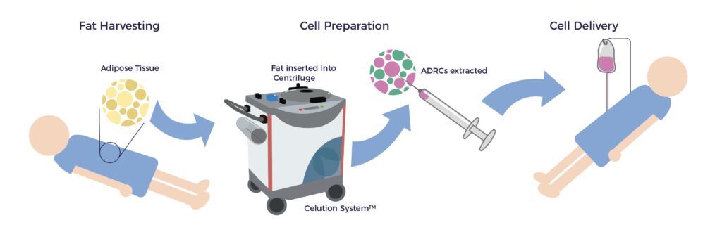 Patient Process | AMBROSE Cell Therapy